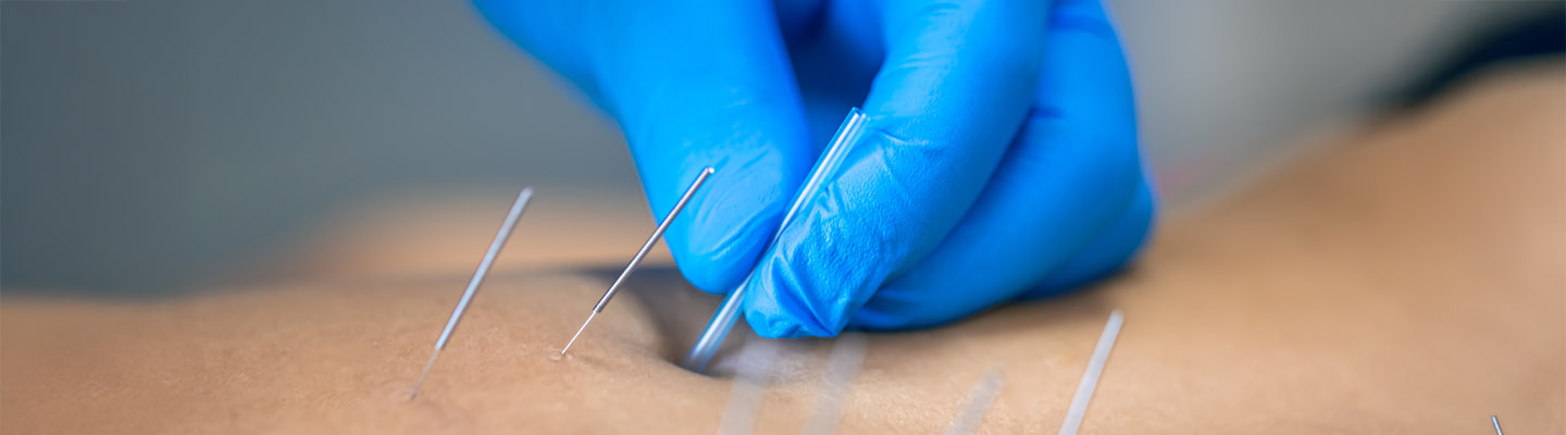 Fysiotherapeut doet een dry needling behandeling